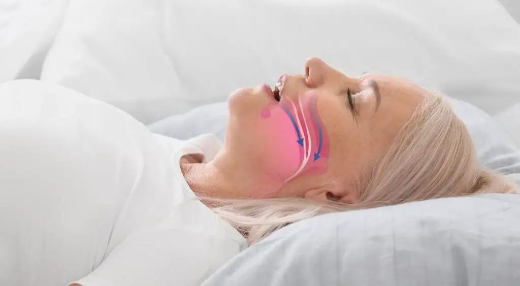 showing airway during obstructive sleep apnea
